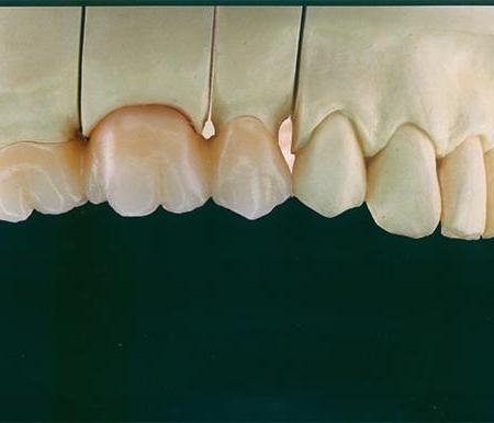 multilayer zirconia prosthetics